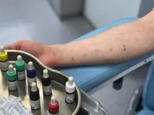 Як підготуватися до здачі аналізів на алергію у Львові